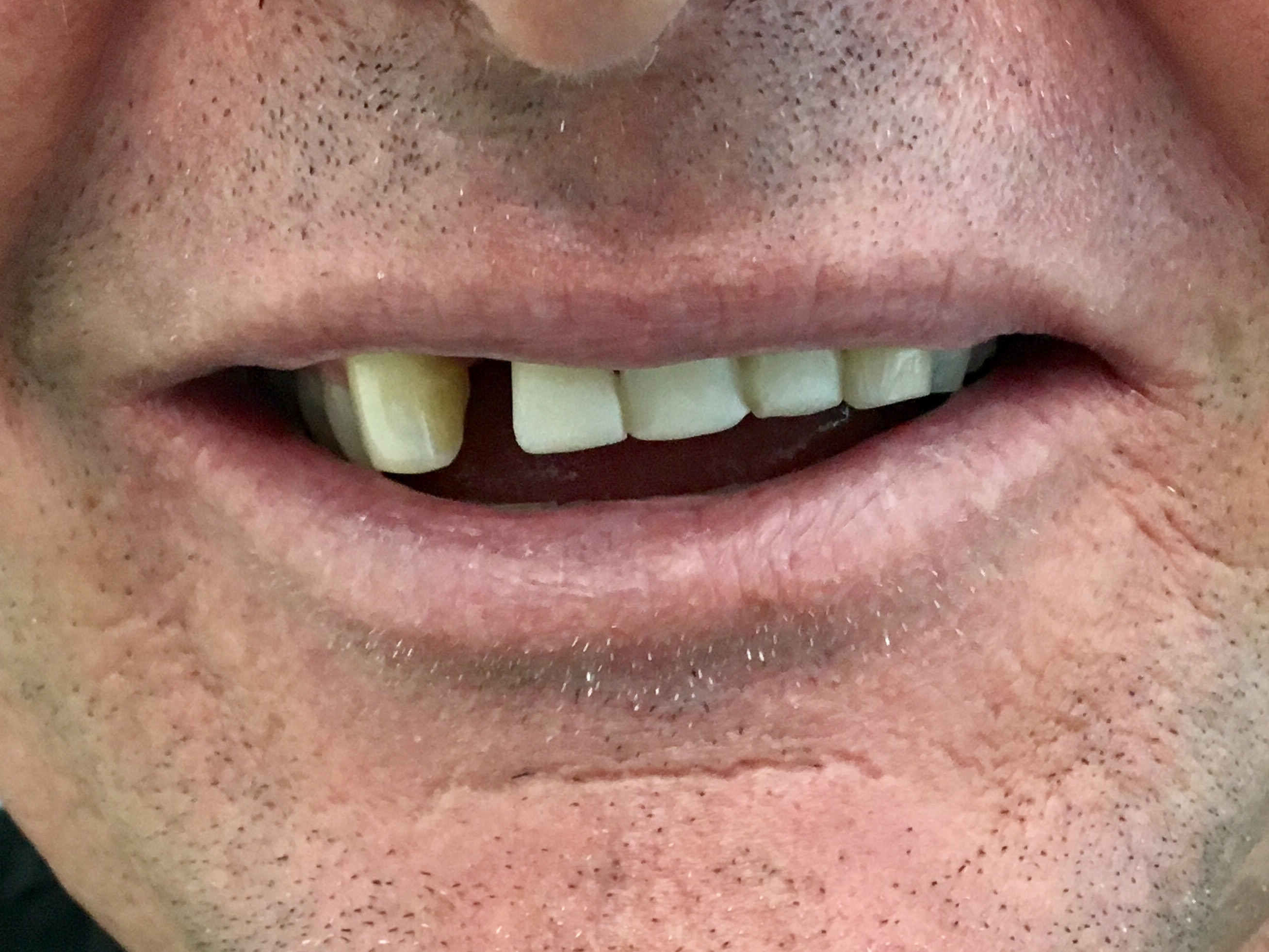 Review Implant Bangkok Dental Dentist Clinic By Bangkok Smile Dental 